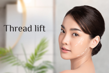 Thread lift